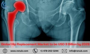 Moving Forward with Hip Replacements: Global Market Projected to Grow to USD 9 Billion by 2028 – Renub Research