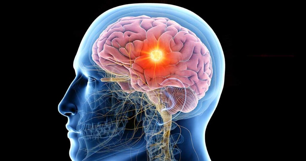 What is mean by Epilepsy ? What is mean by Epilepsy ?